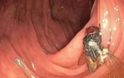 ذبابة داخل أمعاء رجل تحير الأطباء!