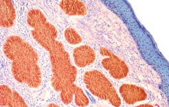 دراسة أسترالية تتوقع انخفاض معدل الإصابة بسرطان الجلد بين الأطفال