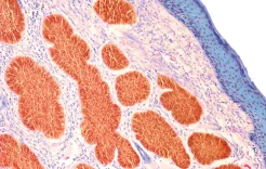 دراسة أسترالية تتوقع انخفاض معدل الإصابة بسرطان الجلد بين الأطفال
