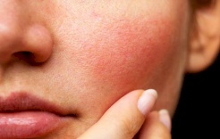 حمض اللاكتيك بديل الريتينويدات للعناية بالبشرة الحساسة