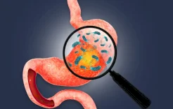 تشخيص دقيق وعلاج معقد.. كيف نواجه بكتيريا المعدة؟