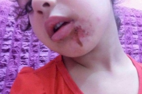  صور| جدة عراقية تتجرد من ضميرها وتعذب حفيدتها بطريقة لا تصدق