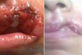 هذا ما فعله طبيب تجميل بشفتي فتاة مصرية..والقضاء ينصفها