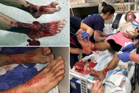 فيديو| آكلات للحوم هاجمت هذا المراهق وكادت تقتله نهشاً بقدميه
