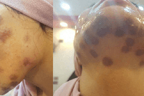 صورة| ضحية جديدة لعمليات التجميل تشوه وحروق!