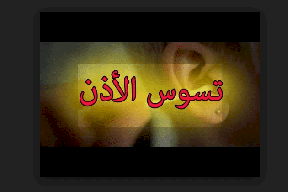 هل سمعت يوماً عن "تسوّس الأذن" ؟!