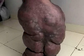 بعد لسعة بعوضة له.. اصبحت رجله هكذا!