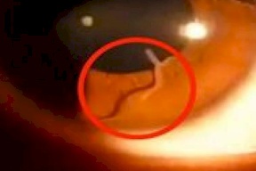 صور| لقطات مروعة لدودة تخرج من عين سيدة