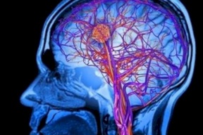 هكذا تتجنب خطر السكتة الدماغية