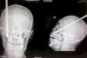 نجا من الموت.. رغم دخول قضيب لمسافة 20 سم بدماغه