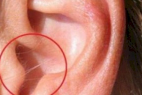 هام جداً.. هل لديك شعر على أذنك؟