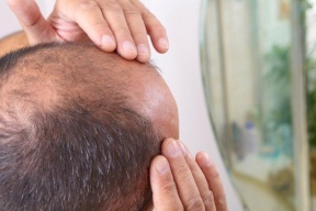 علاج "مفاجئ" للصلع .. برائحة جميلة تستخدم للعطور