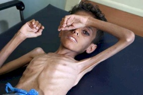 14 مليون شخص “على حافة المجاعة” في اليمن