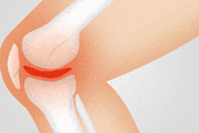 متى يستخدم الكورتيزون لعلاج التهاب المفاصل؟