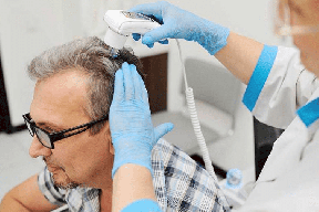 معلومات مهمة عن عملية زراعة الشعر