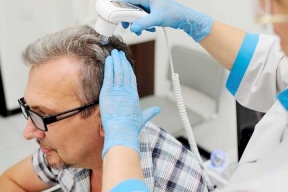 معلومات مهمة عن عملية زراعة الشعر
