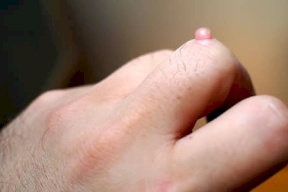 الثالول : نصائح طبيعية للتخلص منه