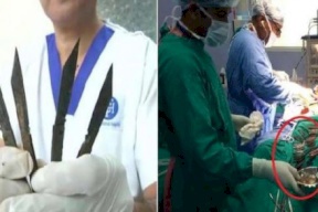 استخراج 40 سكيناً من معدة هندي بعملية استغرقت 5 ساعات