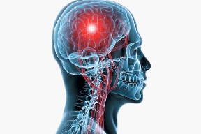 لماذا يصاب الشباب بالسكتة الدماغية؟