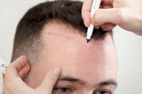 ما الذي يمكنك توقعه بعد زراعة الشعر؟