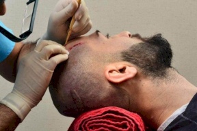 وفاة رجل بعد عملية زراعة شعر!