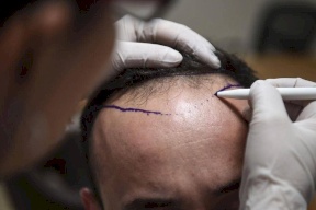 توفي بعد زراعته الشعر.. ماذا قال الاطباء؟