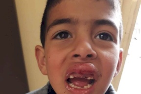 اصابة طفل دهسه مستوطن بالخليل