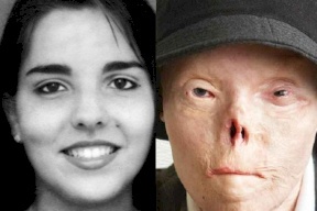 تعرف على قصتها الملهمة..شوهها حادث فباتت أيقونة للتوعية