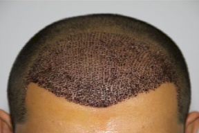 توفي بعد زراعته الشعر.. ماذا قال الاطباء؟