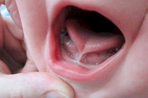 اللسان المربوط يعيق الطفل عن الرضاعة الطبيعية !