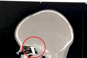 بالصور.. أطباء يستخرجون رصاصة من رأس رضيعة في نابلس