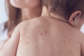 بعد إعلان أميركا خلوها من الحصبة.. 33 حالة والمرض يتفشى