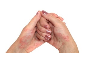 5 نصائح لمواجهة الصدفية خلال حرارة الصيف