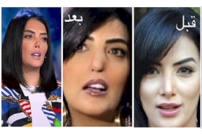 هل خضعت حورية فرغلي لعملية تجميل جديدة فاشلة؟