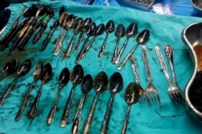 استخراج 20 ملعقة ومجوهرات من بطن مريض مصري