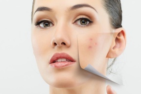 أطعمة قد تتسبب بظهور البثور على البشرة