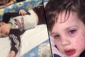 بسبب قبلة.. رضيع سيعاني من "فيروس هربس" مدى الحياة