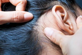 مفاجأة .. علاج "لقمل الرأس" يمكنه قتل كورونا خلال 48 ساعة!