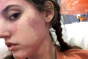 صور: بسبب مرض غريب.. بريطانية "تتناول" غذاءها عن طريق القلب