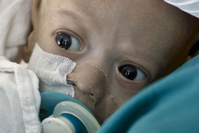 الأطفال في خطر..  مرض جديد يهدد العالم