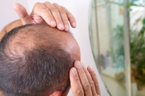 القهوة وتساقط الشعر.. ما العلاقة بينهما؟