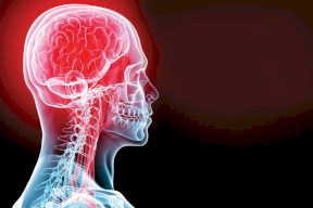 هكذا يمكن تقليل احتمالات الإصابة بسكتة دماغية