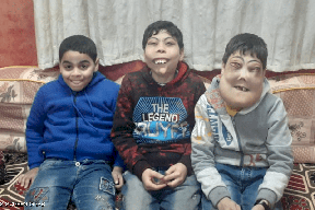 "اخلع القناع".. معاناة طفلين مصريين مع المرض النادر!