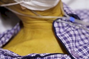 صور- رجل صيني يفاجئ الأطباء بعد تحول جلده إلى اللون الأصفر