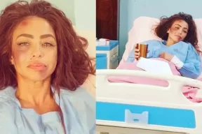 دوللي شاهين لم تُضرب .. وهذا سبب الكدمات على وجهها!