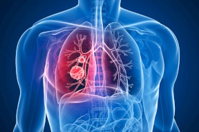 الصحة: 70% من مرضى سرطان الرئة في فلسطين هم من المدخنين والمدخنين السابقين