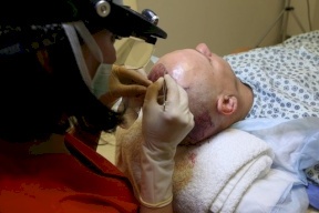 خلال 6 أشهر.. أكثر من نصف مليون شخص أجروا عمليات زراعة شعر في تركيا