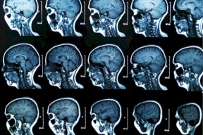 التصوير بالرنين المغناطيسي يكشف عن تشوهات كبيرة في الدماغ بعد التعافي من كورونا!