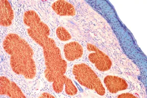 دراسة أسترالية تتوقع انخفاض معدل الإصابة بسرطان الجلد بين الأطفال