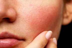 حمض اللاكتيك بديل الريتينويدات للعناية بالبشرة الحساسة